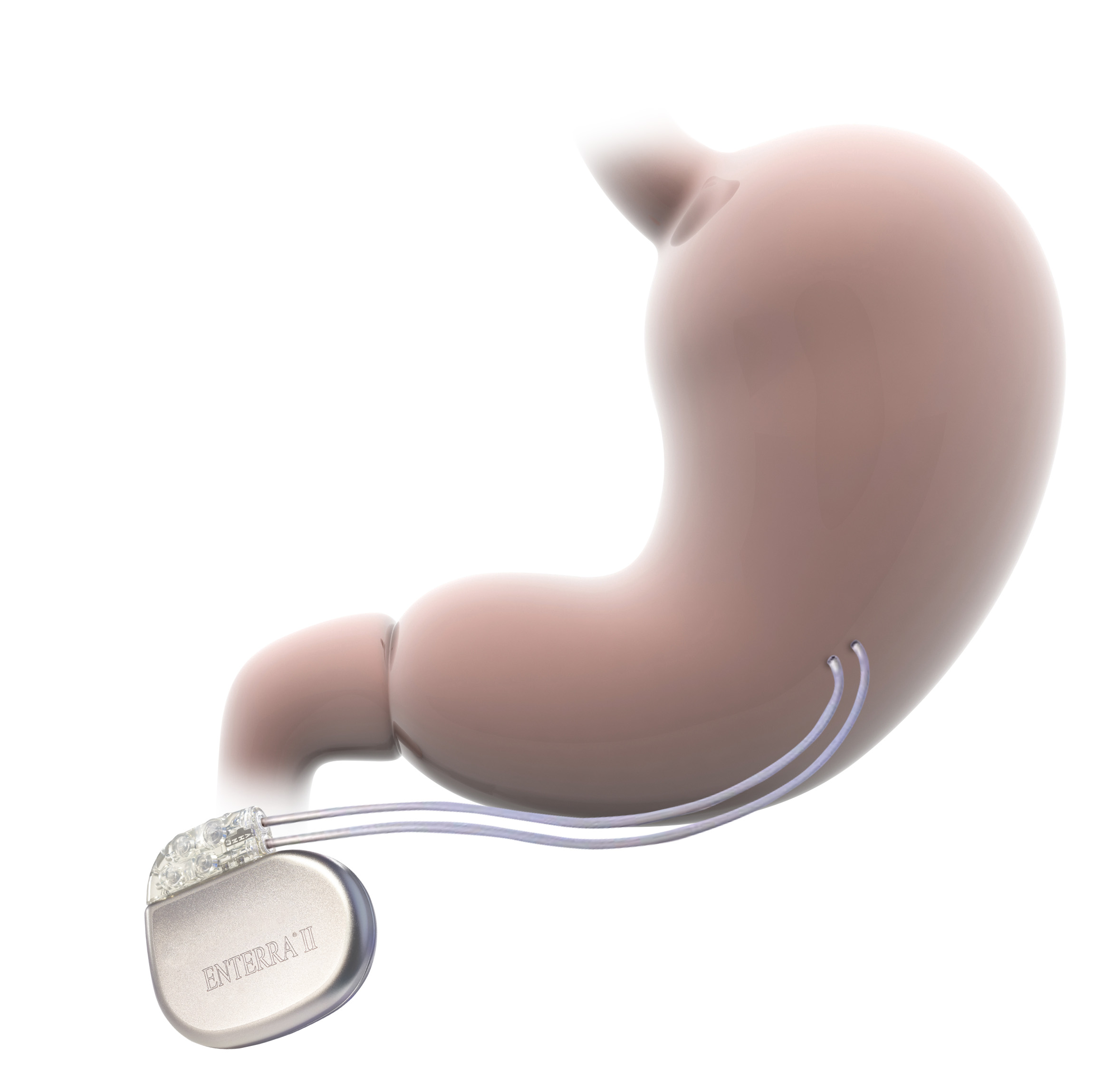 Enterra 2 implanted into stomach