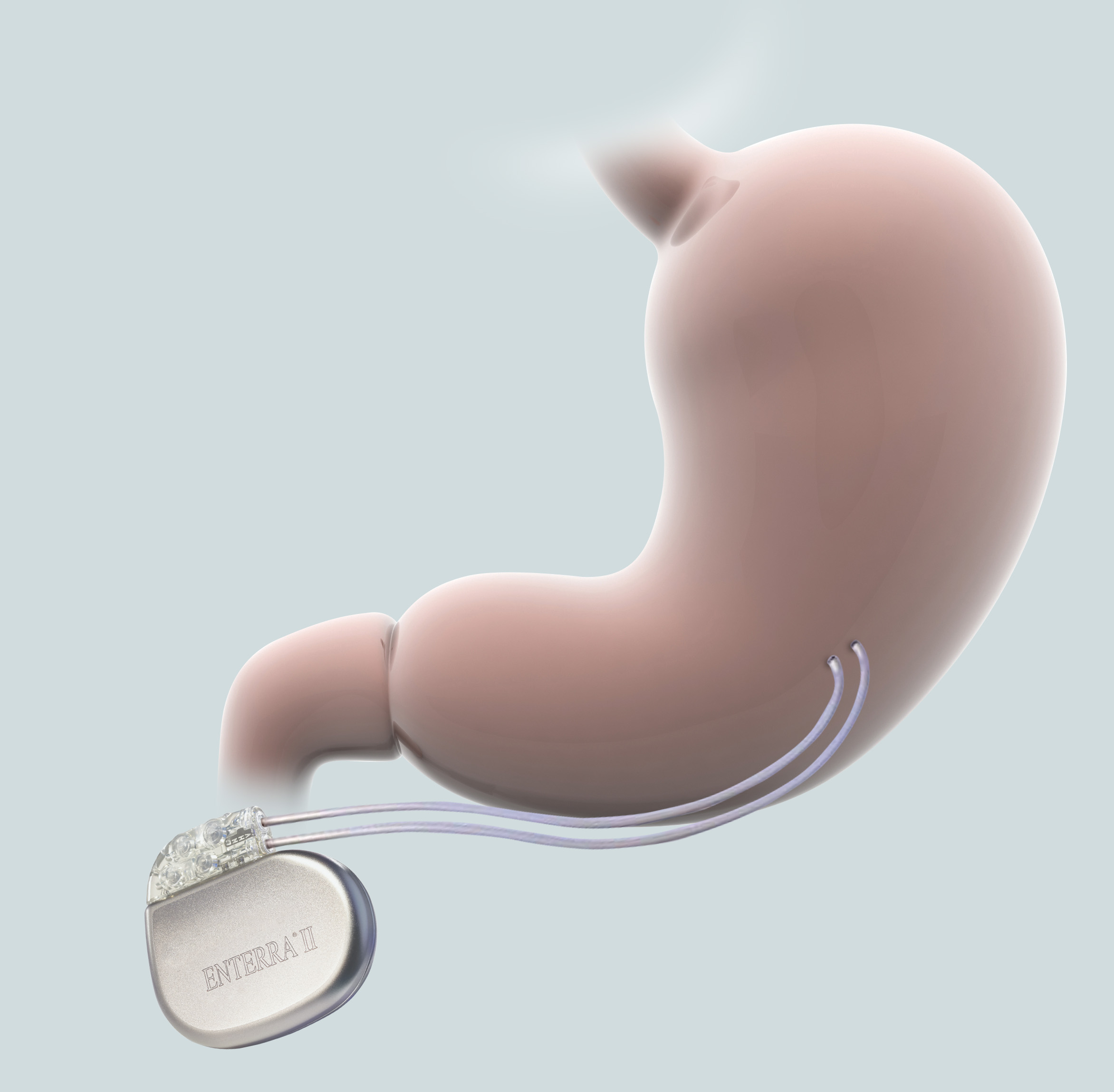 Enterra 2 implanted into stomach with blue background