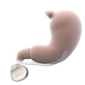 Enterra 2 implanted into stomach